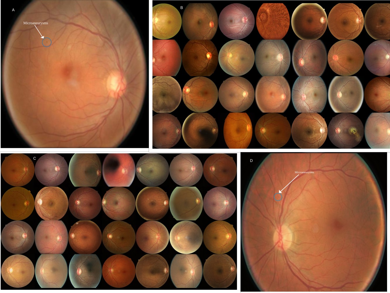 Artelus comparison between real and fake Diabetic Retinopathy level 1 images