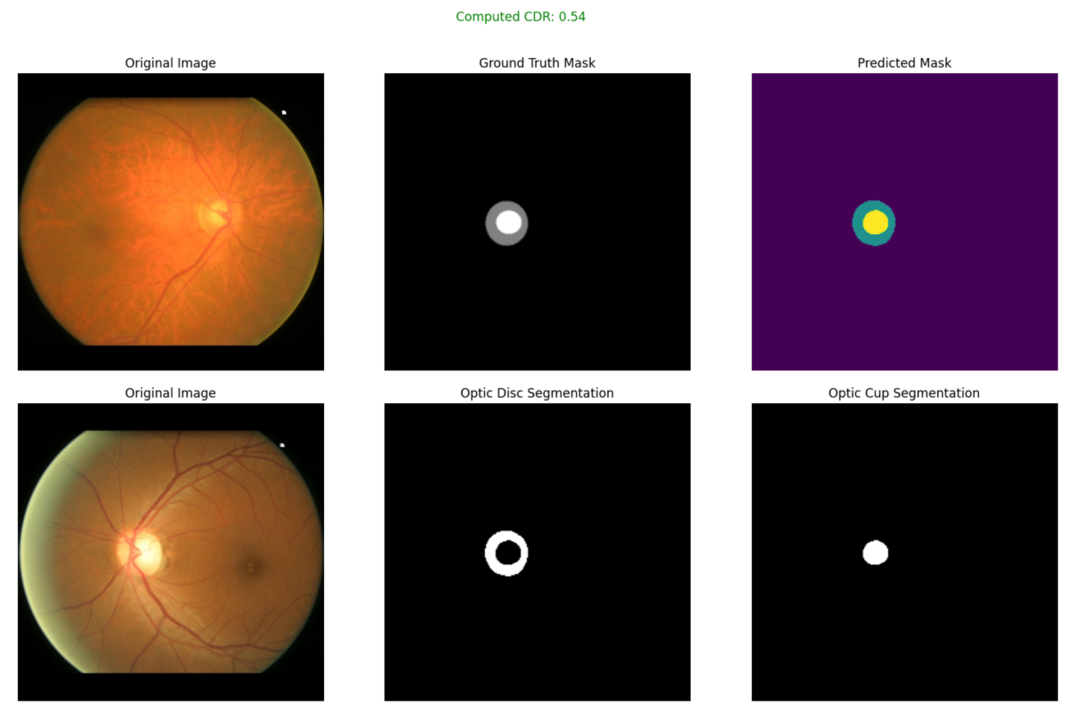 Artelus detects glaucoma by computing Cup to Disc ratio from a single fundus image